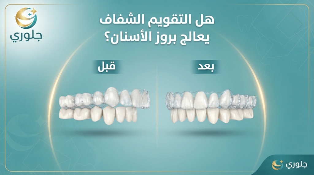 هل التقويم الشفاف يعالج بروز الأسنان