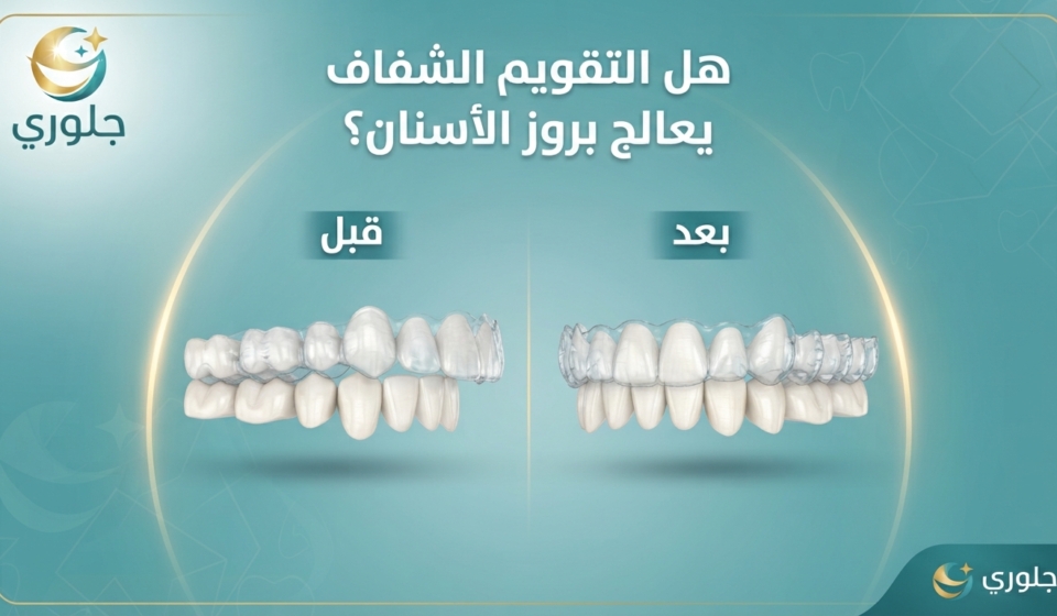 هل التقويم الشفاف يعالج بروز الأسنان
